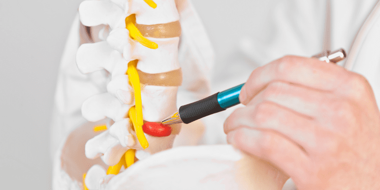 Maqueta de una columna con una hernia discal