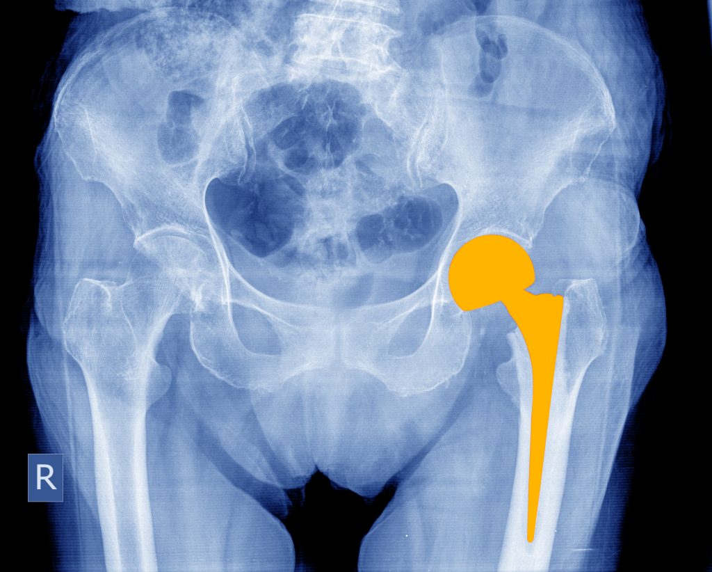  Readaptación para prótesis de cadera y rodilla