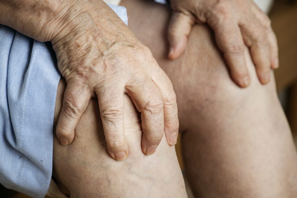 Diferencia entre linfedema y lipedema